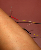 Close up picture shows the needles and micro clips leading to the electroacupuncture unit.  Electroacupuncture is extremely effective at relieving pain.
